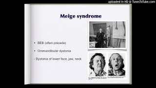 Botulinum toxin in Meiges syndrome [upl. by Bennie102]