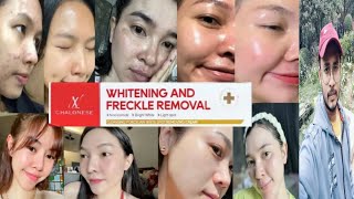 Chalonese Whitening Freckle Removal Cream  Honest Review [upl. by Attena]