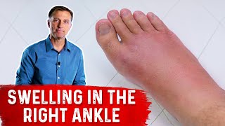 What Causes Right Ankle Edema [upl. by Benetta]