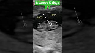 8 Weeks 5 Days Ultrasound Babys First Heartbeat and Development [upl. by Iahs270]