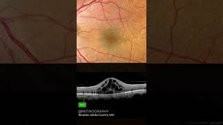 Cystoid macular edema [upl. by Inohs]