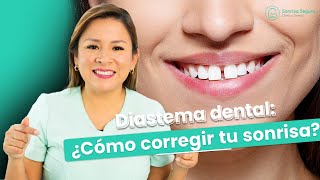 Diastema dental Como corregir tu sonrisa [upl. by Yerbua]