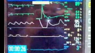 DC Cardioversion of SVT [upl. by Akselav625]