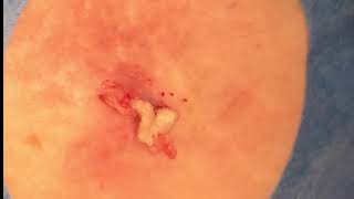 Cyst Explodes Just Missing Camera Doctor Works Hard to Extract it All [upl. by Aimahs565]