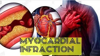 Myocardial infarction explained symptoms assessment Diagnosis and treatment [upl. by Einot]