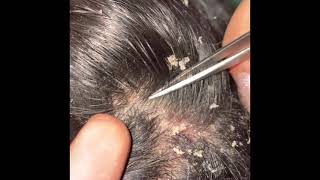 Picking and combing through dandruff psoriasis scalp scratching flare up [upl. by Nagam1]