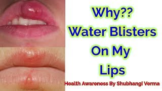 Why water blisters on my lips  Home remedy for Water Blisters on lips [upl. by Nadine438]