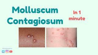 Molluscum Contagiosum Causes symptoms and treatment [upl. by Retrop654]