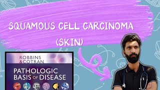 SQUAMOUS CELL CARCINOMA OF SKIN PATHOLOGY ROBBINS BASIS [upl. by Elocim]