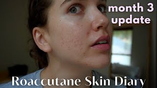 Roaccutane Daily Skin Diary  Month 3  The Purge Continues Low Dose  ft Temu Haul [upl. by Bluma]