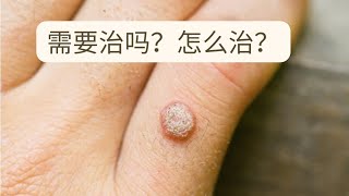 疣的治疗 Warts treatment [upl. by Maitilde566]