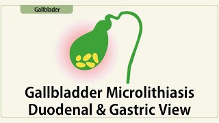 Gallbladder Microlithiasis Duodenal amp Gastric View [upl. by Layap]