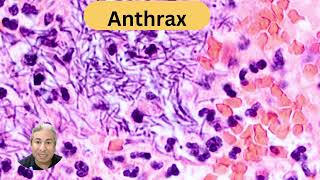 Anthrax enterocolitis [upl. by Duthie]