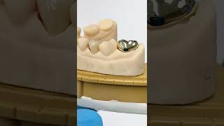 Zen Enamel Premolar and Gold Crown EnvisiontecMain envisiontec lsk121shorts dentistteeth [upl. by Lemieux]