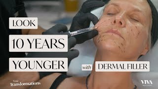 Look 10 Years Younger With Dermal Filler  Before amp After  Total Transformations Ep 5 [upl. by Snoddy514]