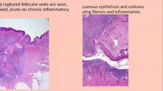 Lecture164 Hideradenitis suppurativa Rooks Chapter 92 [upl. by Vivianna]