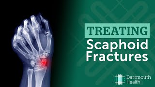 Treating Scaphoid Fractures at Dartmouth Health [upl. by Baese]