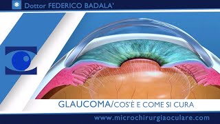 GLAUCOMA Cosa è e Come si Cura [upl. by Tayib7]