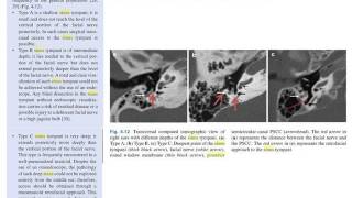 types of sinus tympani [upl. by Colwin399]