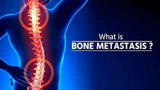 What is bone metastasis  Stage 4 Cancer  Bone Metastasis  How Cancer Spreads  metastasis [upl. by Adolfo558]