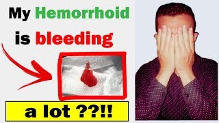 IS Your Hemorrhoid Bleeding A Lot [upl. by Ytitsahc]