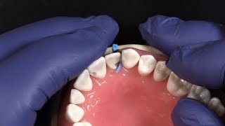 NEW Fusion Anterior Matrix System from Garrison Dental Solutions [upl. by Akkim]