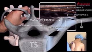 The ESP erector spinae plane Block  Our Current Understanding [upl. by Prue]