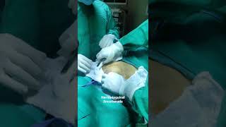 Hernia Inguinal Encarcerada [upl. by Ariel331]