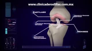 Clinica de Rodillas  Ruptura Parcial Ligamento Cruzado Anterior LCA  México [upl. by Fang470]