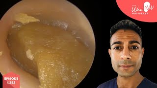 1282  Very Impacted Ear Wax Removal [upl. by Ilaw]