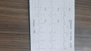 LEARN ECG VENTRICULAR BIGEMINY WITH RBBB IN 2 MINUTES [upl. by Tletski]