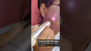 Birthmark removal Nevus of Ota By Q switch NdYAG laser ✅ [upl. by Retsehc807]