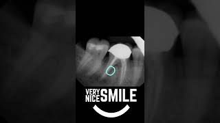 Failing Root canal xray [upl. by Nyrahs]