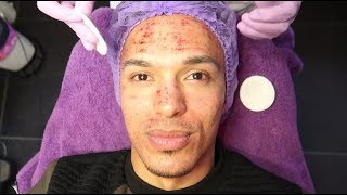 FACIAL NEEDLING TEGEN LITTEKENS  Alfredo Hernando  VLOG67 [upl. by Sugna510]