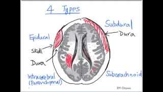 Intracranial Bleed  Part 1 [upl. by Ilonka]