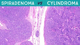 Spiradenoma vs Cylindroma Dermpath in 5 Minutes pathology dermatology dermatopathology sweat gland [upl. by Kra]