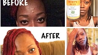 Burts Bees Natural Acne Solutions Review before and after [upl. by Xavier]