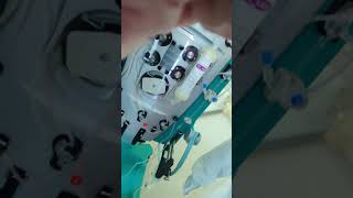 Plasmapheresis TPE Manoj Palackel 12 [upl. by Joacimah500]