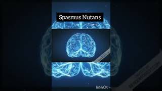 Spasmus Nutans [upl. by Rovit813]