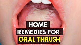 How to Treat Candida at Home  5 Home Remedies for Oral Thrush [upl. by Refinney]