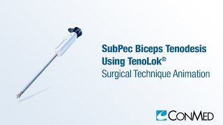 SubPec Biceps Tenodesis Using TenoLok®  CONMED Animation [upl. by Anidualc655]