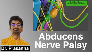 Abducens Nerve Palsy [upl. by Lodge]