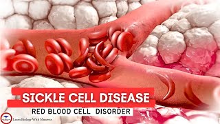 Sickle Cell Disease SCD  Red Blood Cell Disorder [upl. by Anigal983]