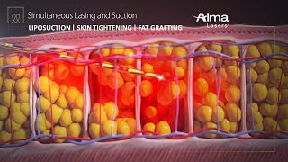 Liposuction Skin Tightening amp Fat Grafting  Lipo Life by Alma Lasers Medical Device 3D Animation [upl. by Ddej]