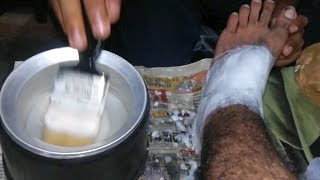 Paraffin wax treatment in physiotherapy Paraffin wax uses in Hindi Paraffin wax benefits Wax [upl. by Gaivn199]