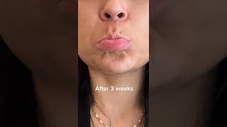 Transform Your Chin Progressive BotoxDysport Results [upl. by Lisabet196]