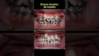 Braces for crowded teeth braces orthodontist dentistry dentist [upl. by Anelrihs]