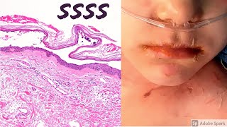 Staphylococcal scalded skin syndrome SSSS 5Minute Pathology Pearls [upl. by Atiz]