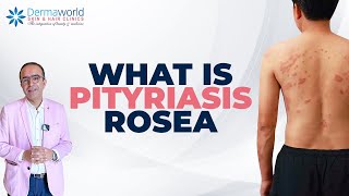 Skin Rash Pityriasis Rosea Hai  Symptoms Aur Treatment Explained  dermaworldskinclinics [upl. by Moyra]