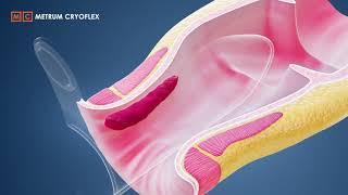 MILH procedure  Minimally Invasive Laser Hemorrhoidoplasty METRUM CRYOFLEX [upl. by Glorianna]